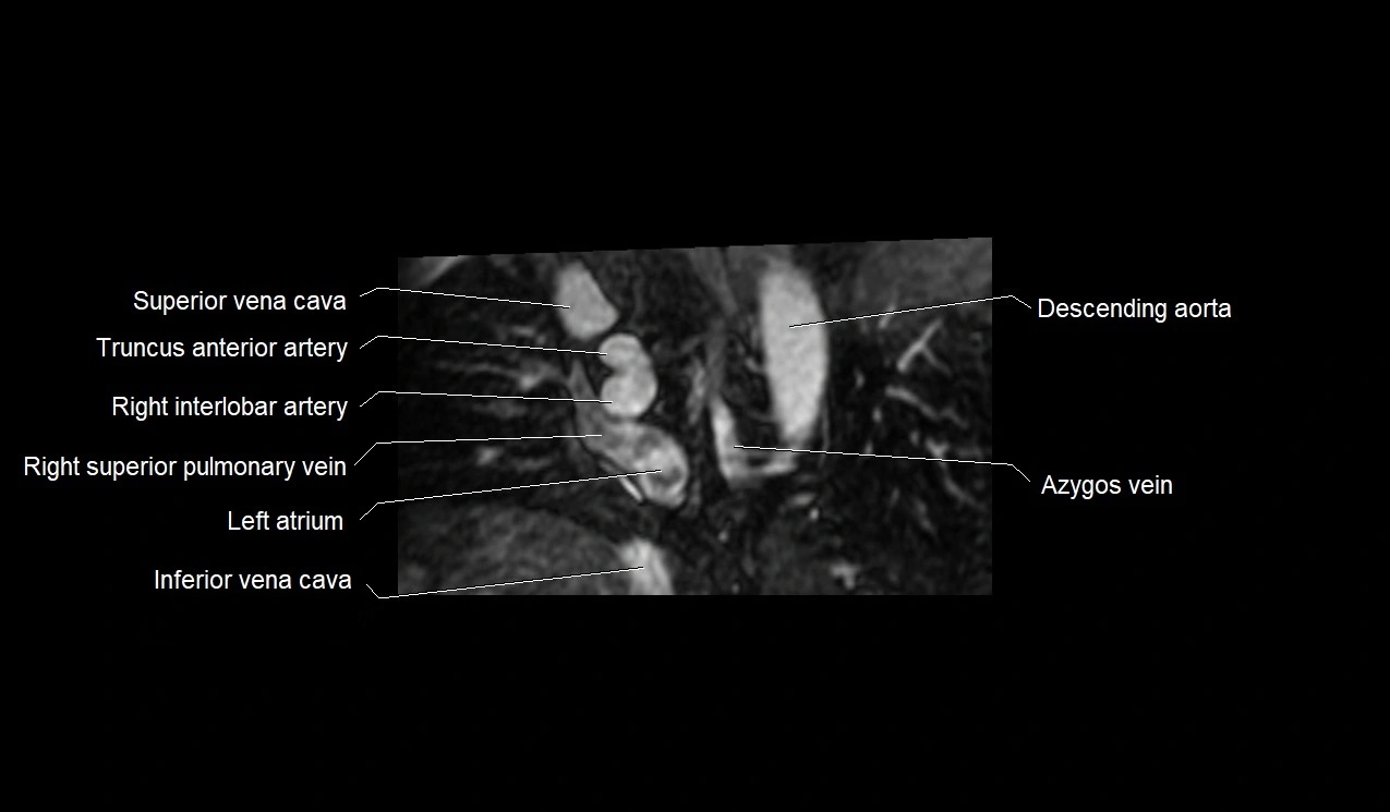 MRI heart and coronary arteries short axis anatomy image 2.webp